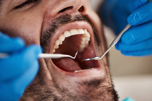 Best Emergency Wisdom Teeth Removal in Argyle, TX